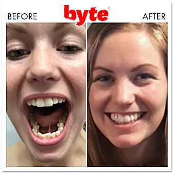 byte before after alyssa