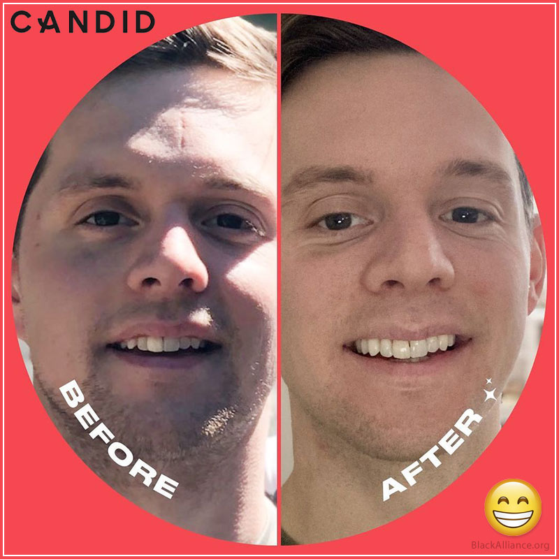 candid aligners before after harold